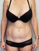 Tummy tuck (Abdominoplasty)