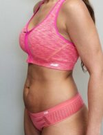 Tummy tuck (Abdominoplasty)