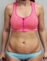 Tummy tuck (Abdominoplasty)