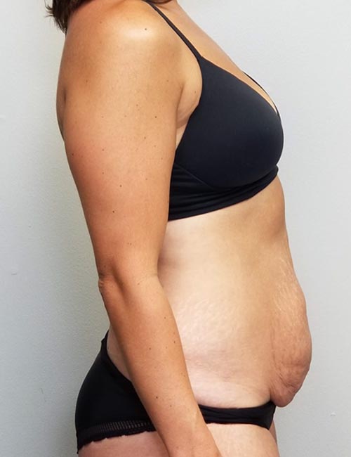Tummy tuck (Abdominoplasty) Case 11358 Before Photo Tummy tuck (Abdominoplasty)