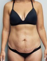 Tummy tuck (Abdominoplasty)