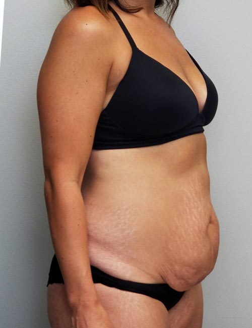 Tummy tuck (Abdominoplasty) Case 11358 Before Photo Tummy tuck (Abdominoplasty)