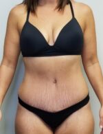 Tummy tuck (Abdominoplasty)