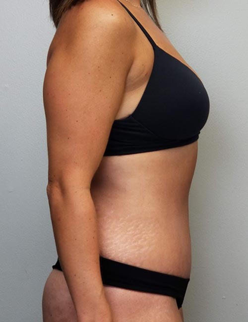 Tummy tuck (Abdominoplasty) Case 11358 After Photo Tummy tuck (Abdominoplasty)
