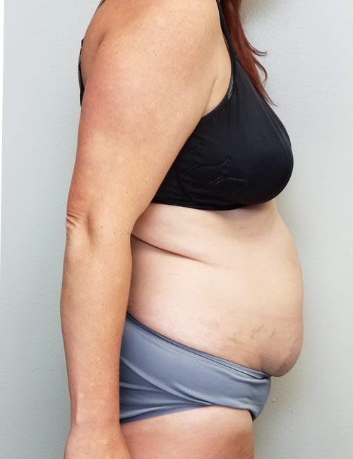 Tummy tuck (Abdominoplasty) Case 11365 Before Photo Tummy tuck (Abdominoplasty)
