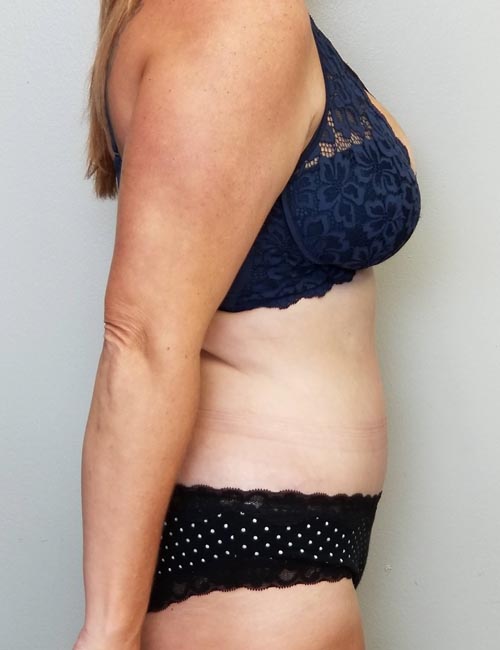 Tummy tuck (Abdominoplasty) Case 11365 After Photo Tummy tuck (Abdominoplasty)