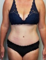 Tummy tuck (Abdominoplasty)