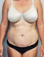 Tummy tuck (Abdominoplasty)