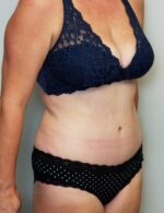 Tummy tuck (Abdominoplasty)