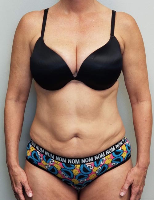 Tummy tuck (Abdominoplasty) Case 11372 Before Photo Tummy tuck (Abdominoplasty)