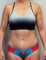 Tummy tuck (Abdominoplasty)