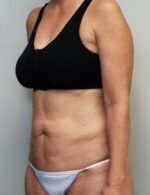 Tummy tuck (Abdominoplasty)