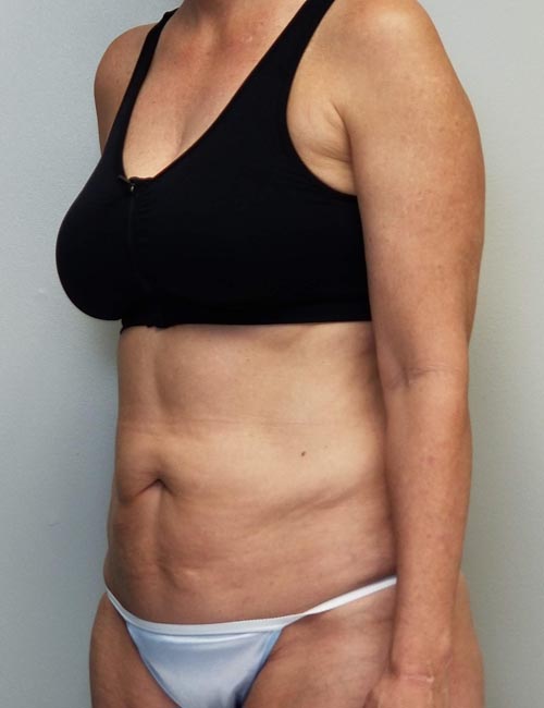 Tummy tuck (Abdominoplasty) Case 11372 Before Photo Tummy tuck (Abdominoplasty)