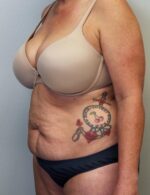 Tummy tuck (Abdominoplasty)