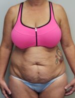 Tummy tuck (Abdominoplasty)