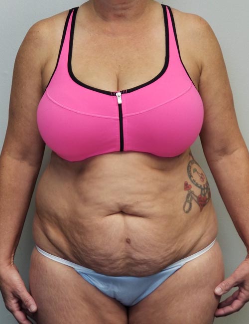 Tummy tuck (Abdominoplasty) Case 11379 Before Photo Tummy tuck (Abdominoplasty)