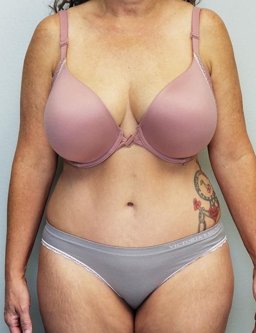 Tummy tuck (Abdominoplasty) Case 11379 After Photo Tummy tuck (Abdominoplasty)