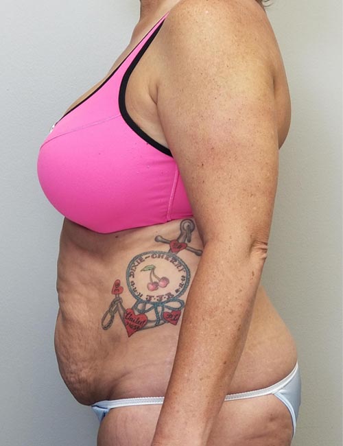 Tummy tuck (Abdominoplasty) Case 11379 Before Photo Tummy tuck (Abdominoplasty)
