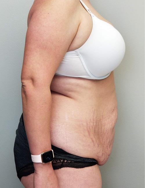 Tummy tuck (Abdominoplasty) Case 11386 Before Photo Tummy tuck (Abdominoplasty)