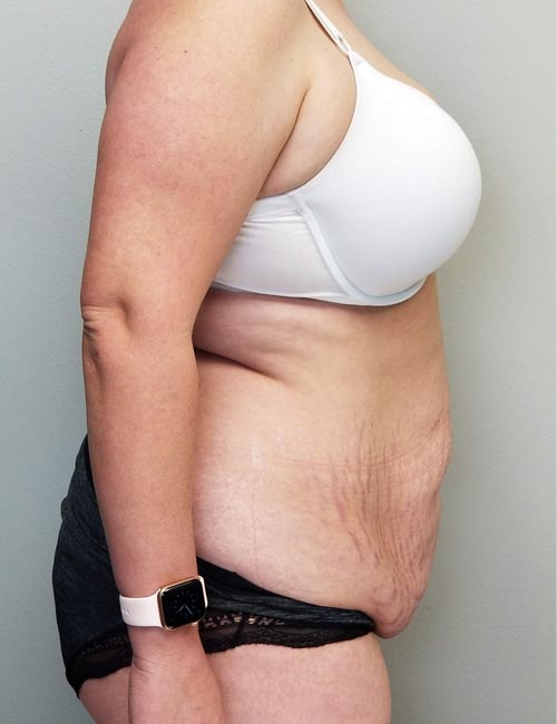 Tummy tuck (Abdominoplasty)