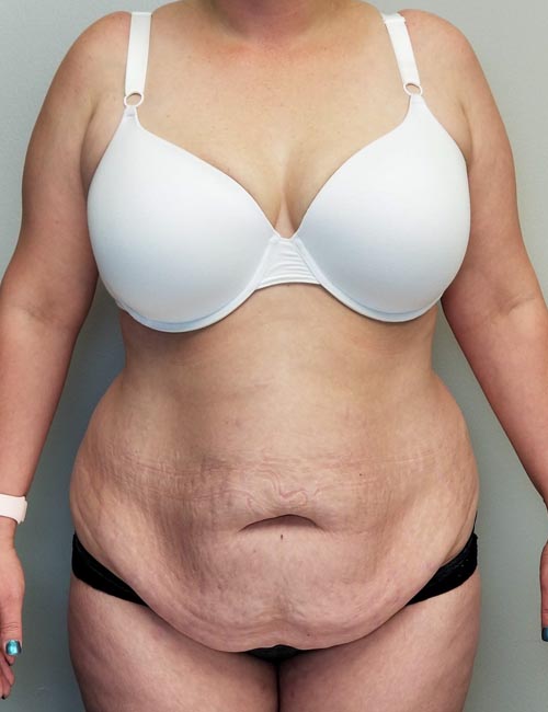 Tummy tuck (Abdominoplasty)