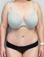 Tummy tuck (Abdominoplasty)