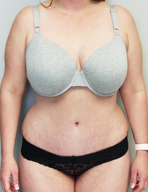 Tummy tuck (Abdominoplasty) Case 11386 After Photo Tummy tuck (Abdominoplasty)