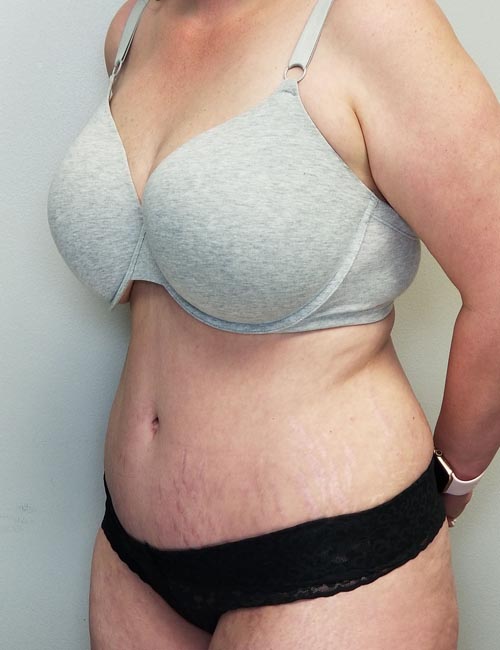 Tummy tuck (Abdominoplasty) Case 11386 After Photo Tummy tuck (Abdominoplasty)