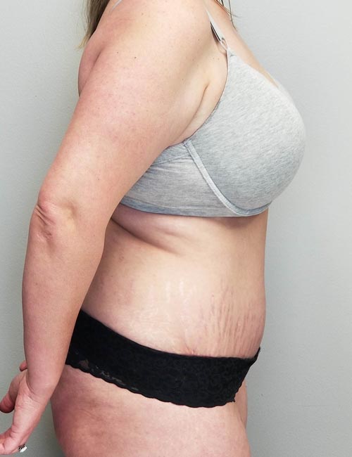 Tummy tuck (Abdominoplasty)