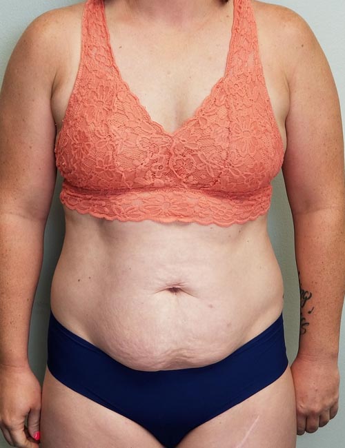 Tummy tuck (Abdominoplasty) Case 11393 Before Photo Tummy tuck (Abdominoplasty)