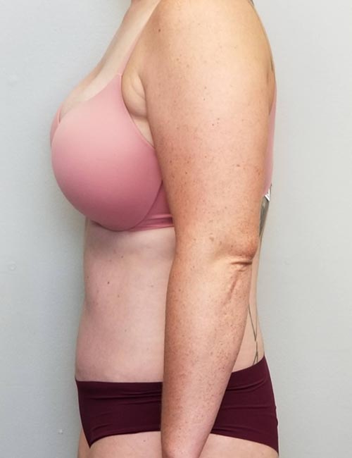Tummy tuck (Abdominoplasty) Case 11393 After Photo Tummy tuck (Abdominoplasty)