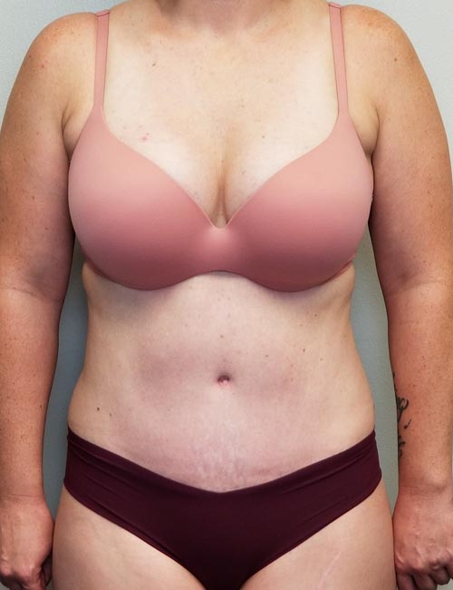 Tummy tuck (Abdominoplasty) Case 11393 After Photo Tummy tuck (Abdominoplasty)