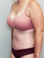 Tummy tuck (Abdominoplasty)