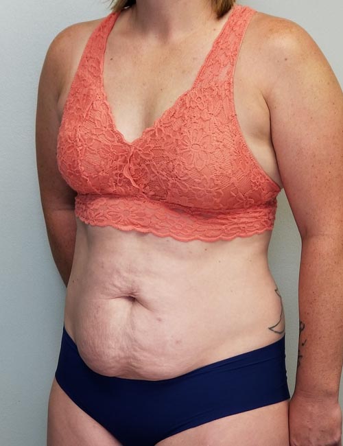 Tummy tuck (Abdominoplasty) Case 11393 Before Photo Tummy tuck (Abdominoplasty)