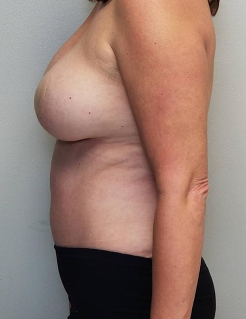 Tummy tuck (Abdominoplasty) Case 11400 After Photo Tummy tuck (Abdominoplasty)
