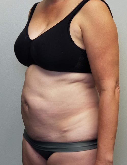 Tummy tuck (Abdominoplasty) Case 11400 Before Photo Tummy tuck (Abdominoplasty)