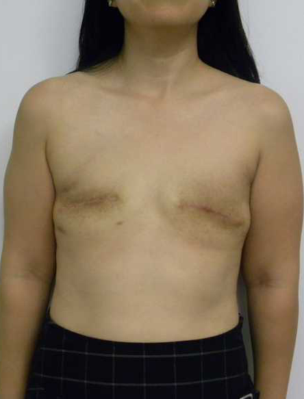 Breast Reconstruction Before & After by Panama City Plastic Surgeon Dr. Ceydeli