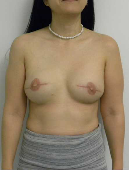 Breast Reconstruction Before & After by Panama City Plastic Surgeon Dr. Ceydeli