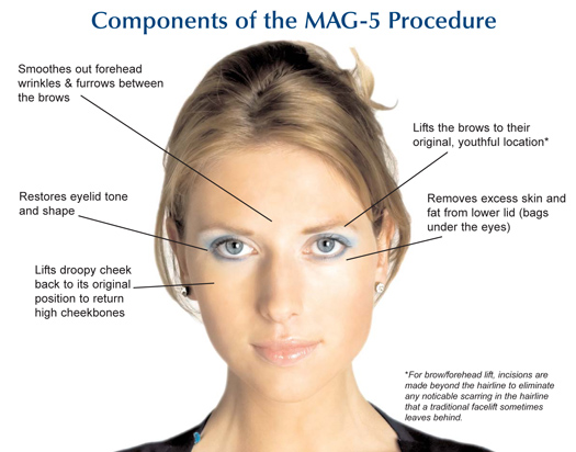 Components of the MAG-5 Procedure