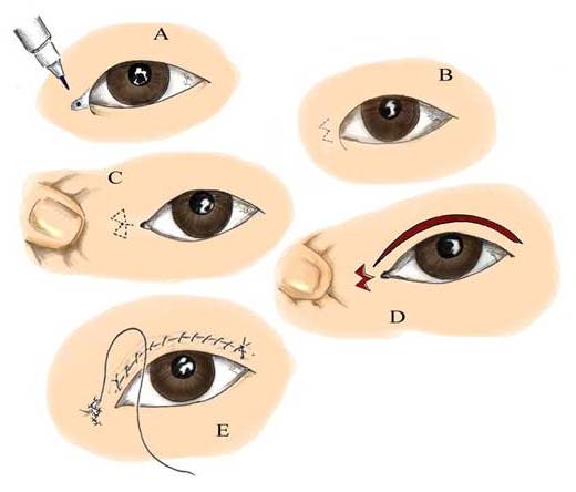 Asian Eyelid Surgery