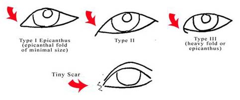 Medial Epicanthoplasty