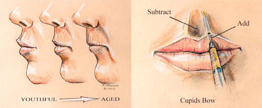 Lip Enhancement Using Fillers