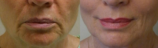 Valentine Mouth Rejuvenation in Panama City by Dr. Ceydeli