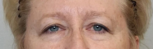 Eyelid Surgery (Blepharoplasty) Before and After Results in Panama City by Dr. Ceydeli