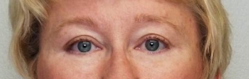 Eyelid Surgery (Blepharoplasty) Before and After Results in Panama City by Dr. Ceydeli