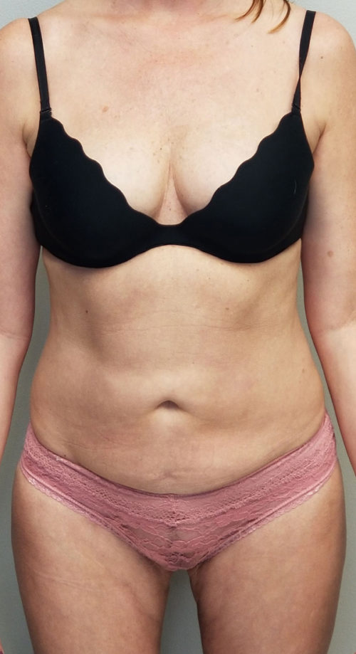 Liposuction Before & After by Dr. Ceydeli in Panama City