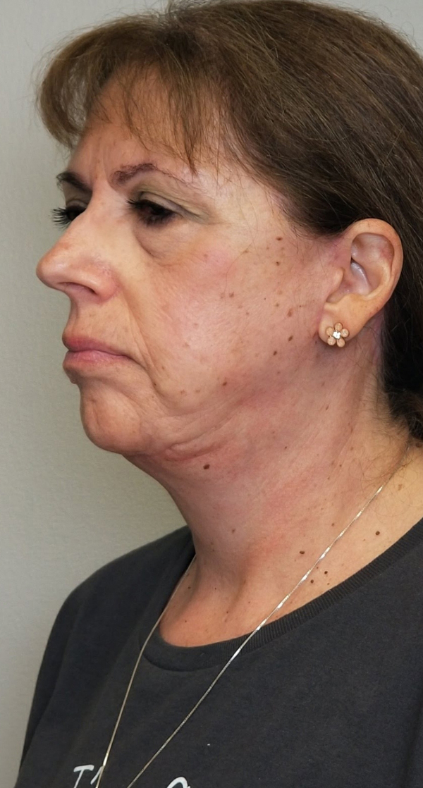 Neck Lift Before & After in Panama City by Dr. Ceydeli