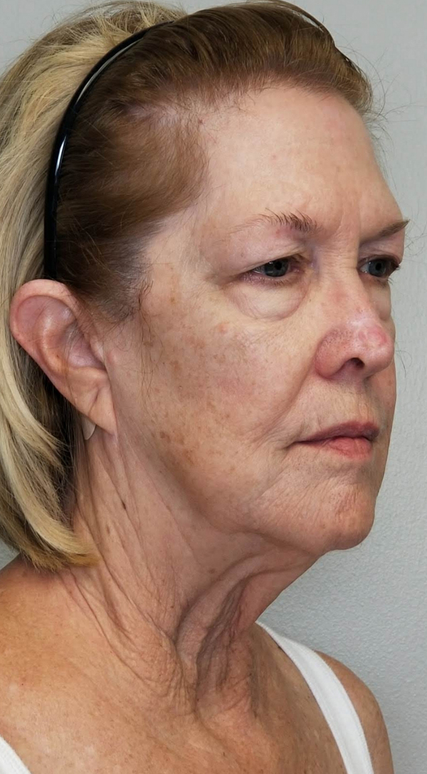 Facelift Before & After in Panama City by Dr. Ceydeli