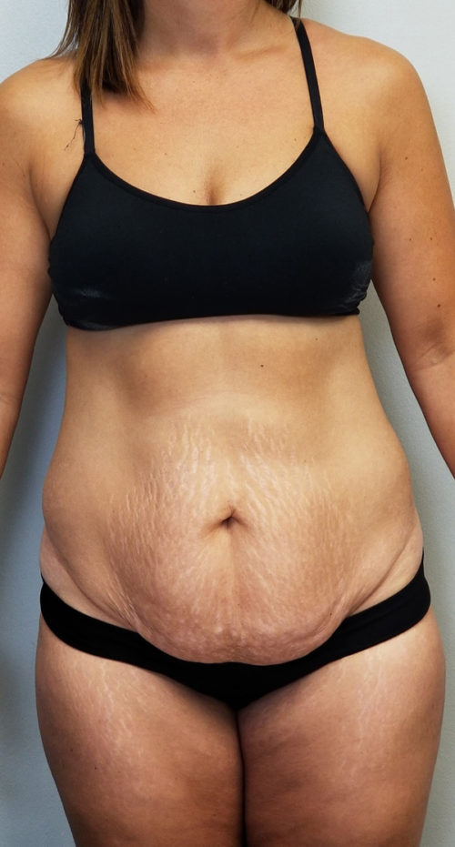 Tummy Tuck Before & After by Panama City plastic surgeon Dr. Ceydeli